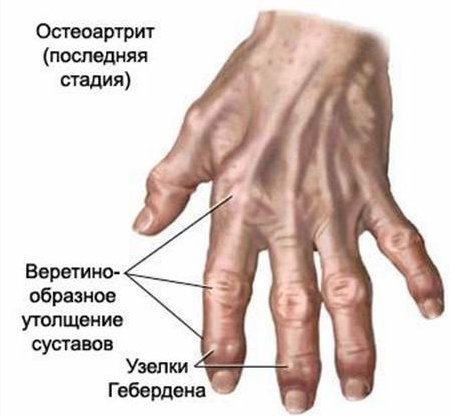 Деформация суставов пальцев рук лечение