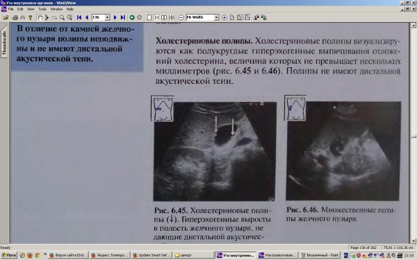 Полип желчного пузыря клинические рекомендации