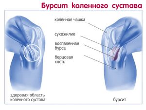 Бурсит колена