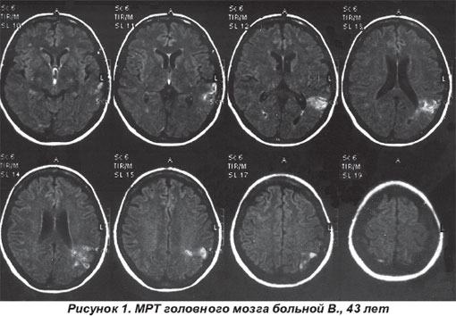 Инсульт на мрт головного мозга картинки