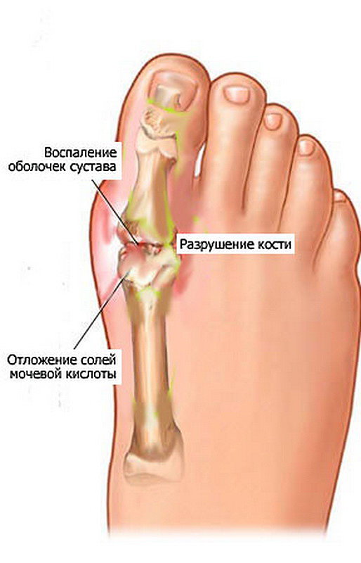 Воспалилась на ноге пальцев косточка. Воспаление большого пальца на ноге.