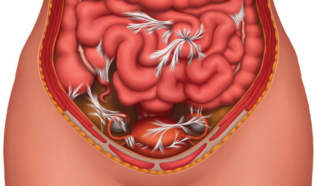 Спаечная болезнь малого таза фото