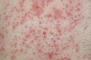A sore rash of small red dots on white skin