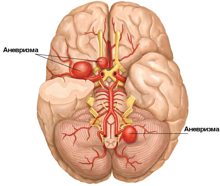 аневризма головного мозга