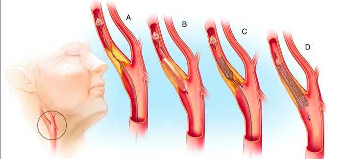 stenirovanie-sonnoy-arterii