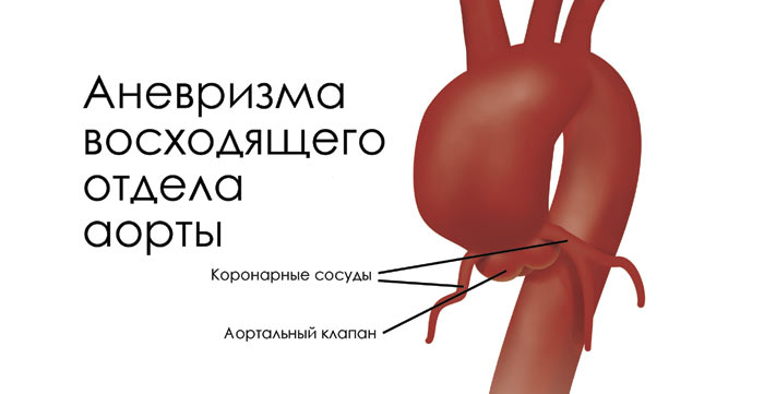 Расширение восходящей. Хирургия аневризма восходящего отдела аорты. Аневризма восходящего отдела аорты операция. Аневризма восходящего отдела аорты(де бейки Тип 1). Восходящий отдел аорты аневризма операция.