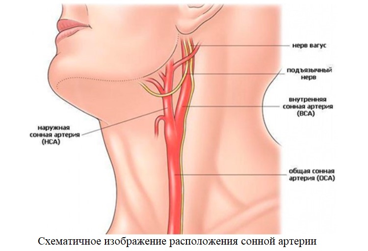 Схематичное изображение расположения сонной артерии