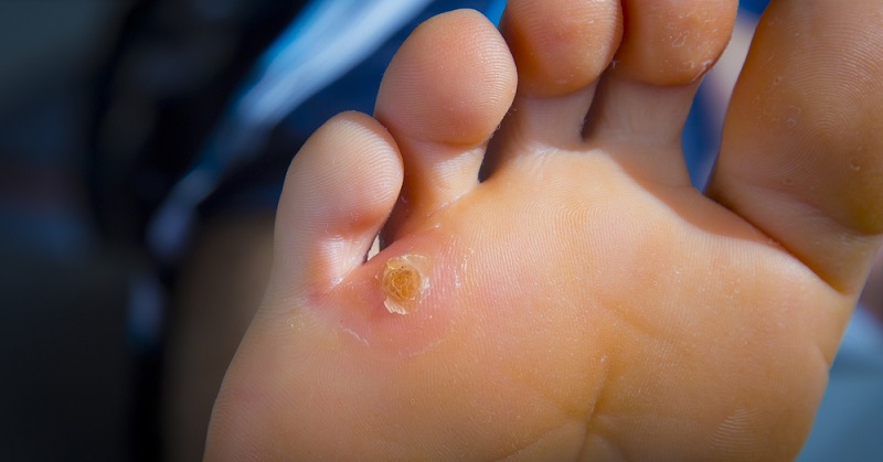 foot corns FI