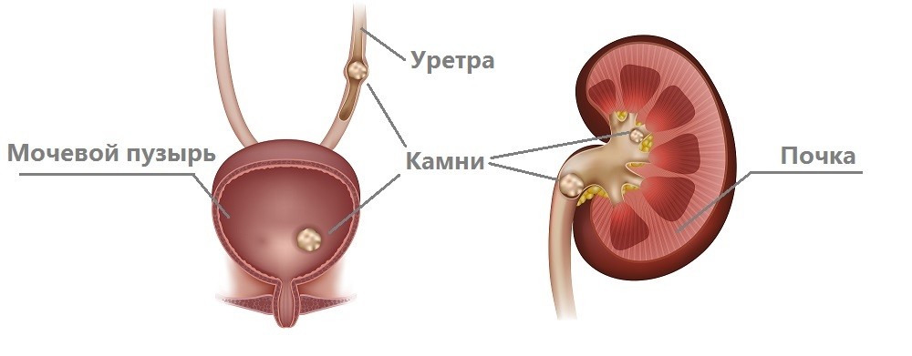 Камни в почках. Движение камня из почки по мочевыводящим путям
