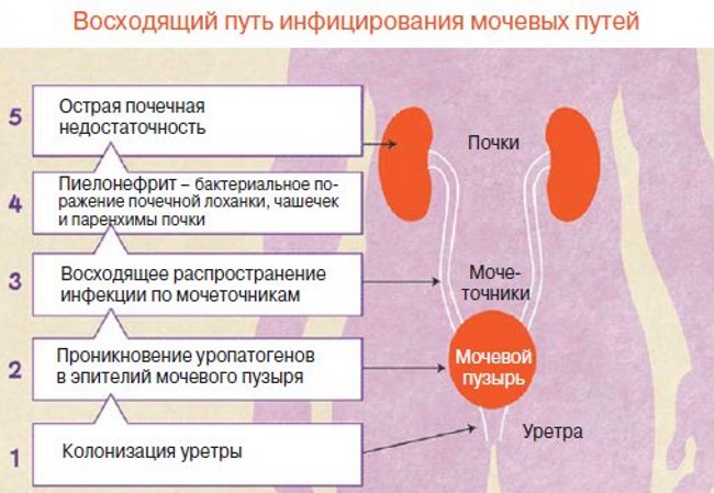 Цистит у женщин фото