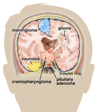 tumor mass effect