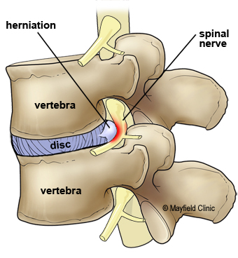 herniated lumbar disc