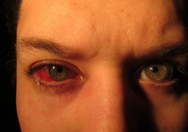 Глаза давление сильное. Субконъюнктивальное кровоизлияние и гифема. Подконъюнктивальный разрыв склеры. Субсклеральное кровоизлияние.