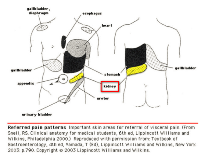 referred pain in kidney areas back