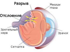 Разрыв оболочки