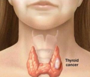 Опухоль щитовидной железы