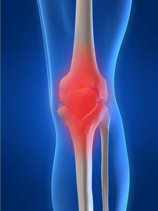 гонартроз 1 степени коленного сустава
