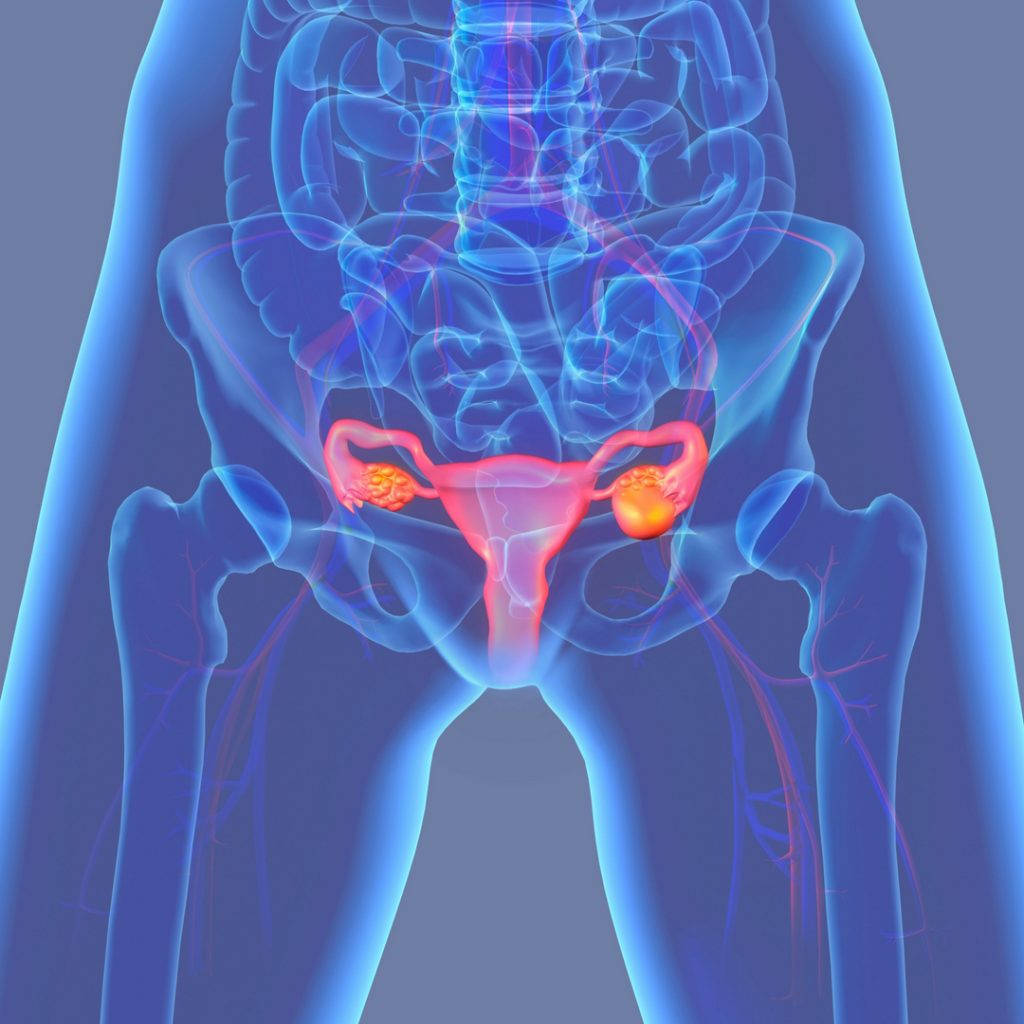 от чего образуется киста яичника у женщин