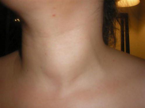 расположение щитовидной железы у женщин фото