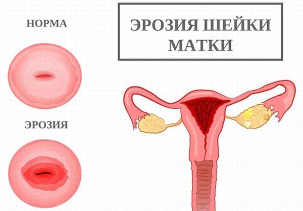 Лечение эрозии шейки матки у нерожавших девушек