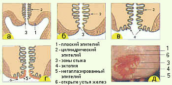 Дисплазия шейки матки