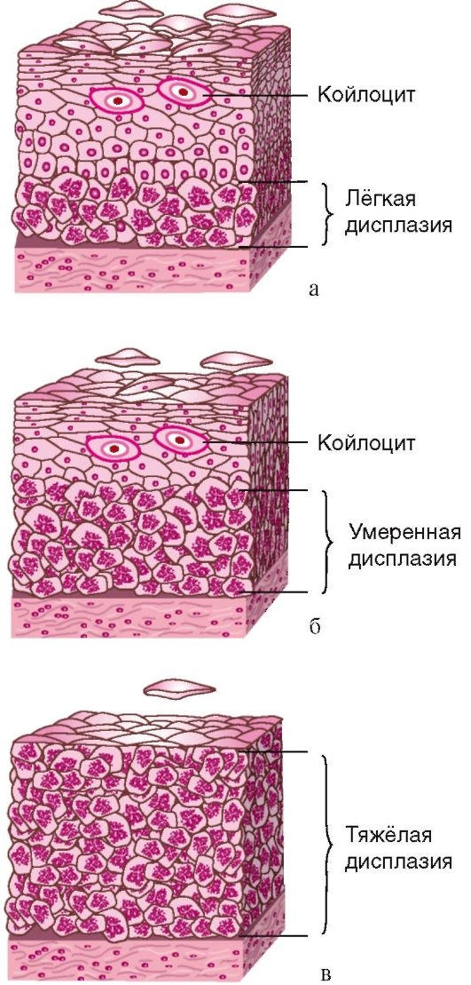 Дисплазия шейки матки