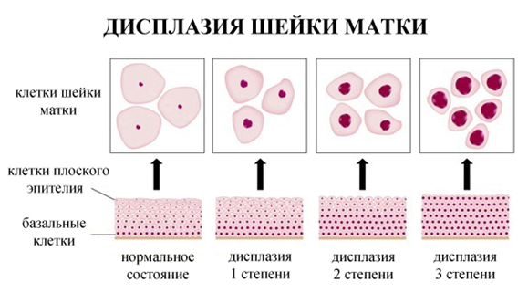 чем опасна дисплазия шейки матки