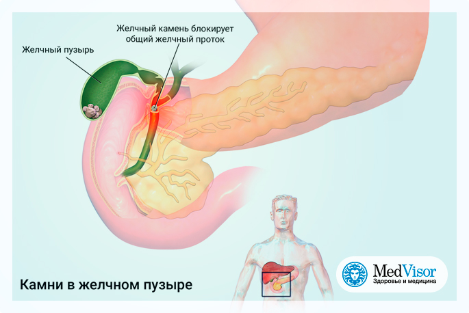 Застой желчи лечение у женщин после 50. Застойный желчный пузырь симптомы. Застой желчи в желчном пузыре симптомы. Застойное содержимое желчного пузыря.