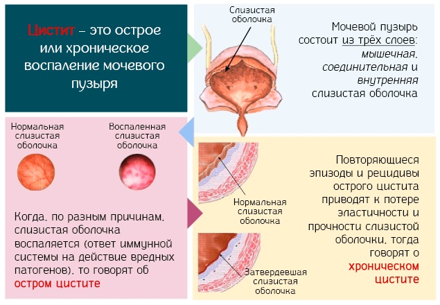 Трихомониаз у женщин. Симптомы и лечение, препараты, народные средства