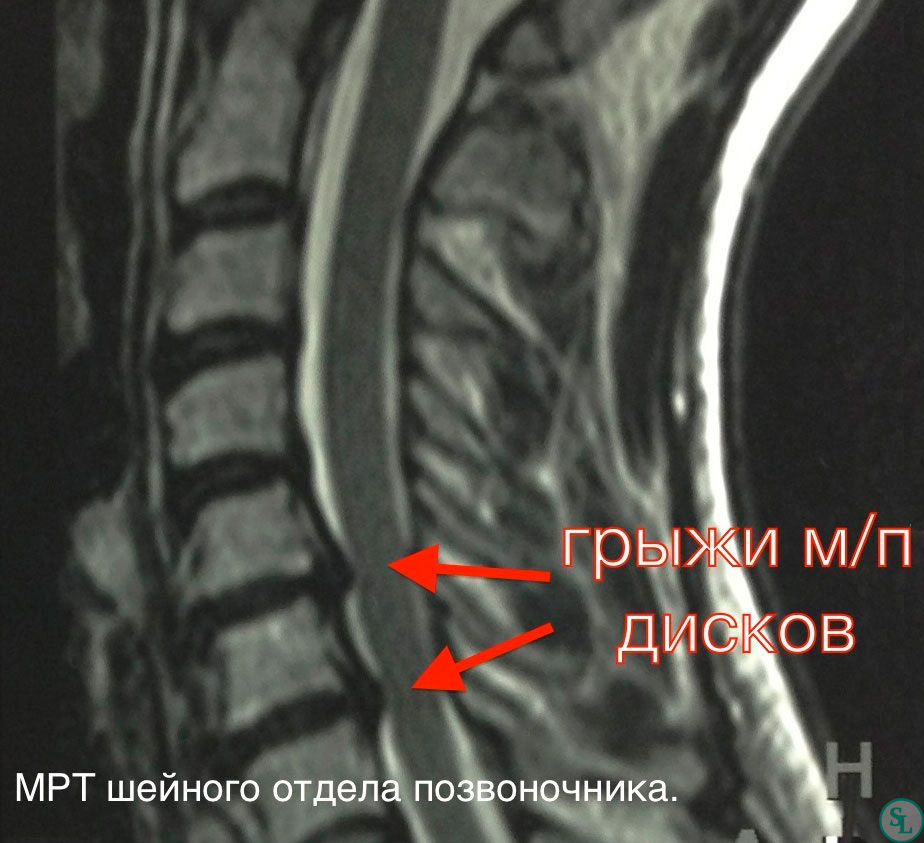 Грыжа шейного отдела позвоночника. Грыжа диска с5-с6, с6-с7. Грыжа с5-с6 шейного отдела мрт. Грыжа шейного позвонка с5 с6 3 мм. Грыжа дисков с5 с6 шейного отдела.