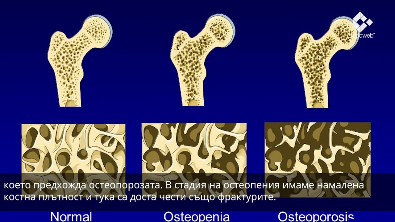 Bone mineral. Остеопороз. Остеопороз кости. Тяжелый остеопороз. Остеопения бедренной кости.