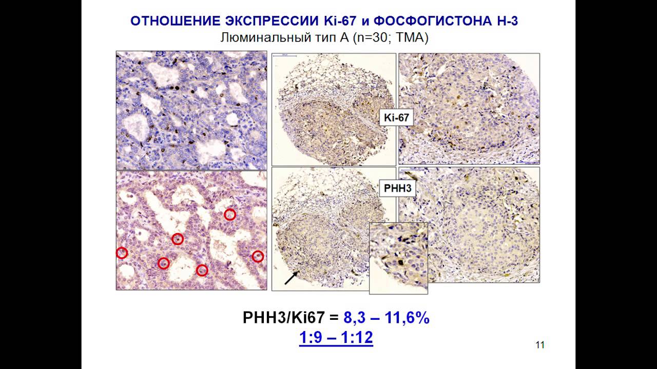 Рмж люминальный тип