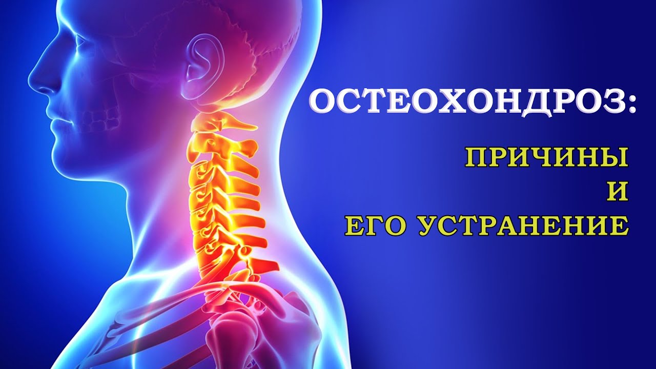 Обострение остеохондроза лечение. Профилактика шейный остеохондроз: Обострение остеохондроза: причины. Остеохондроз с корешковым синдромом: симптомы и признаки. Лечение. Остеохондроз симптомы, диагностика, лечение - Первая клиника Марьино