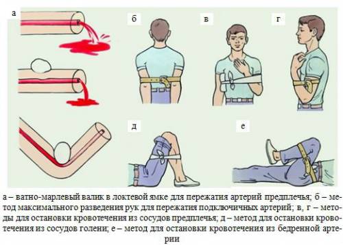 Остановка кровотечения