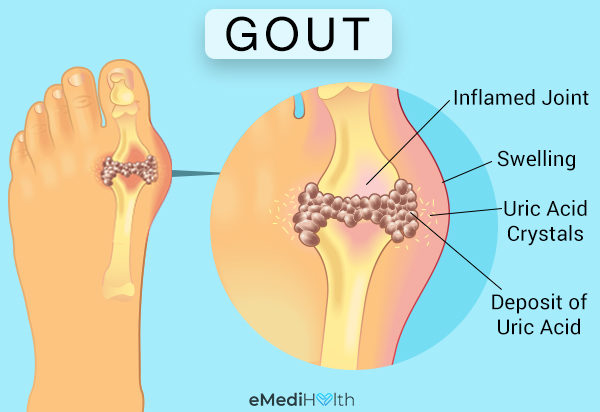 gout uric acid crystals