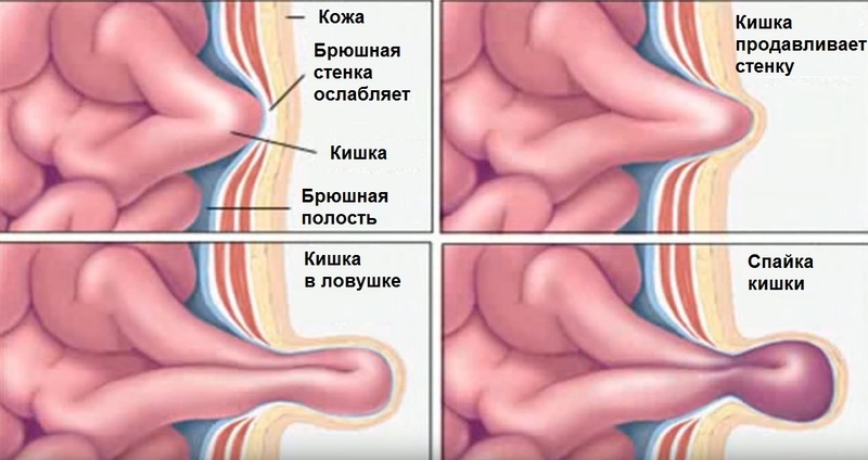 Грыжа в паху у женщин