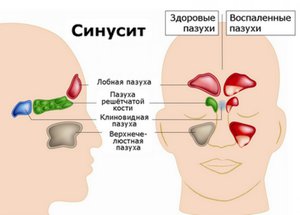 Лечение сунисита с применением капель Фенилэфрин