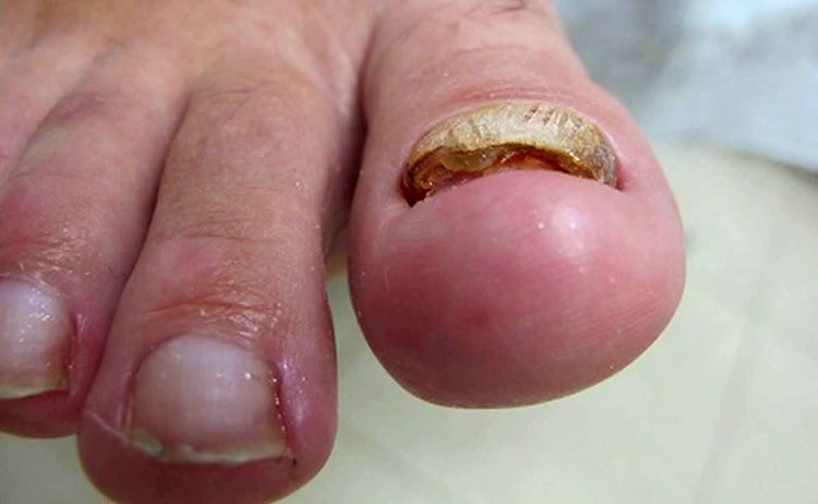 Лечение грибка ногтей в запущенной форме