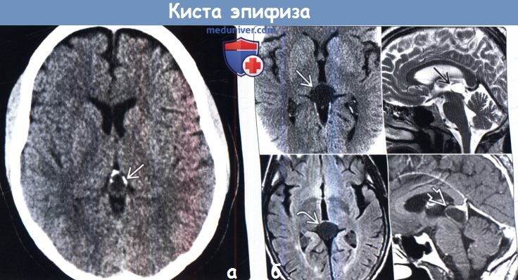 Мрт головного мозга киста шишковидной железы