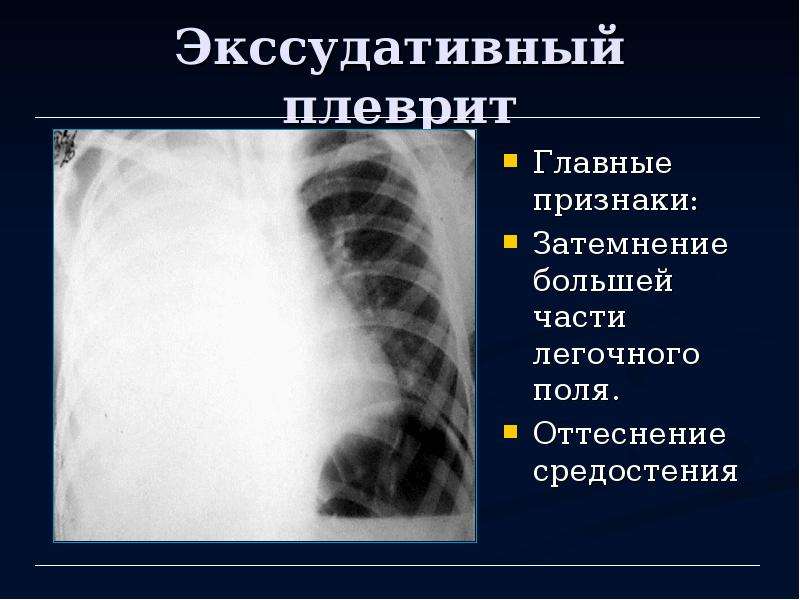 Рентгенологической картиной при экссудативном плеврите является