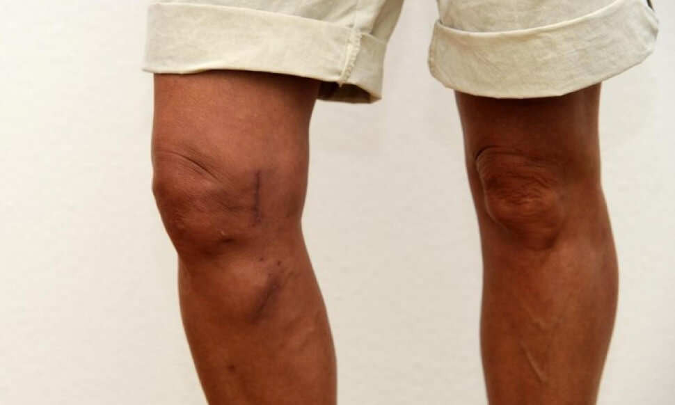 как выглядит артроз коленного сустава