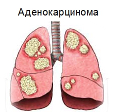 Аденокарцинома лёгких