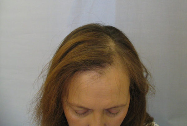 Выпадение волос после лучевой терапии