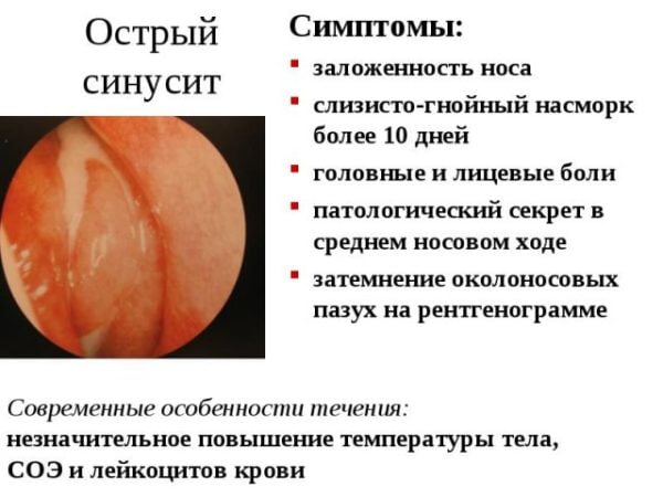 Симптомы острого синусита