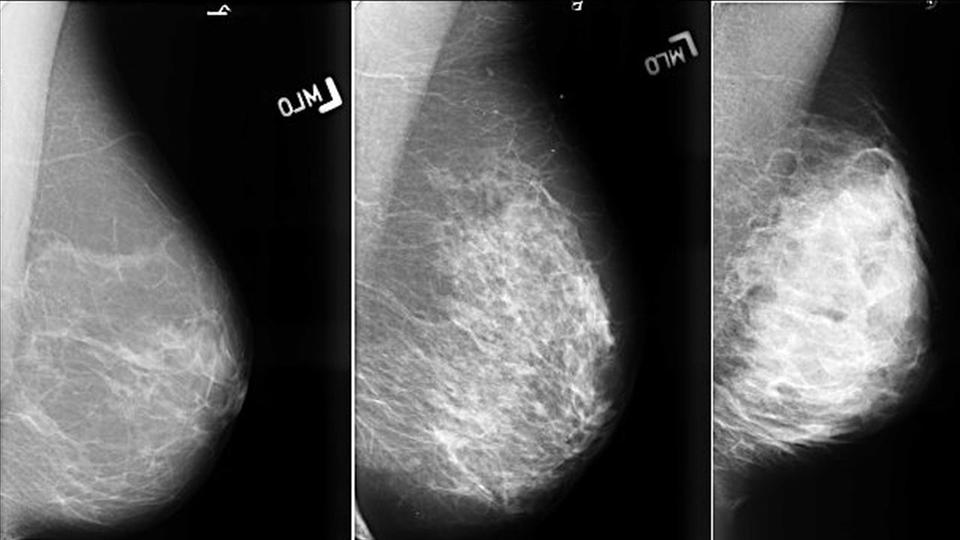Рентгенологическая картина фиброзно жировой инволюции молочных желез