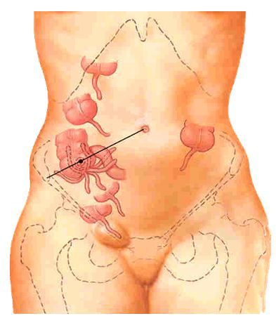 Другие варианты расположения аппендикса