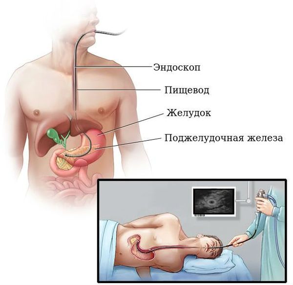Эндосонография Эндосонография