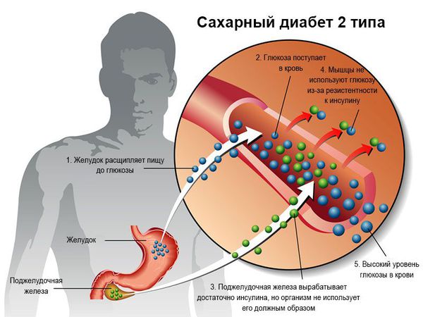 Сахарный диабет 2 типа Сахарный диабет 2 типа