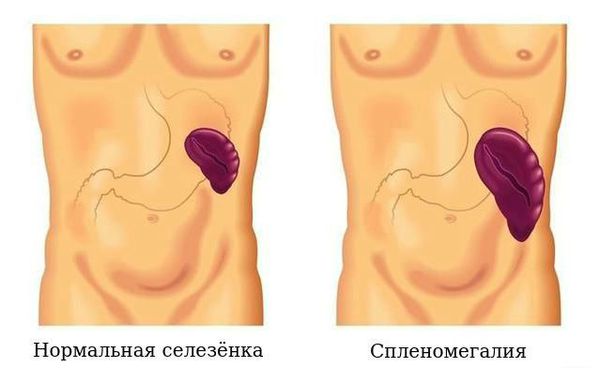 Увеличение селезёнки Увеличение селезёнки