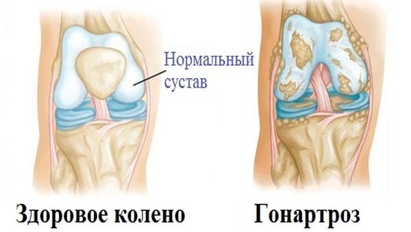 Степени гонартроза коленного сустава
